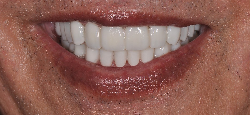 After Hollywood Smile treatment