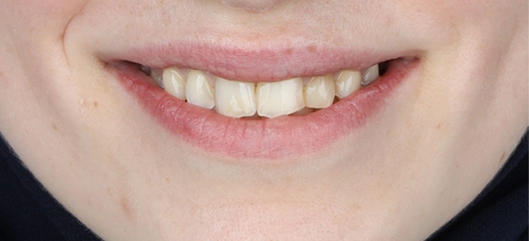 Before Hollywood Smile treatment