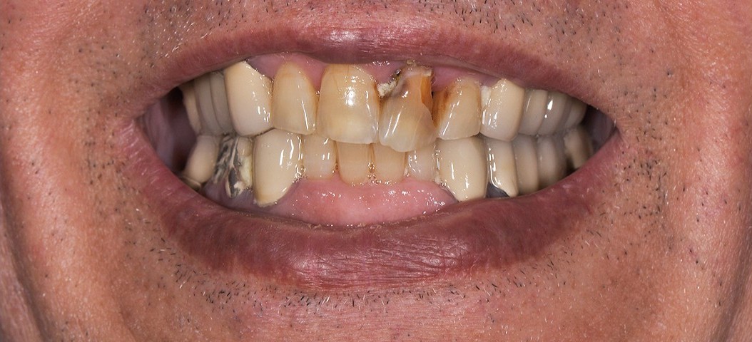 Before Hollywood Smile treatment