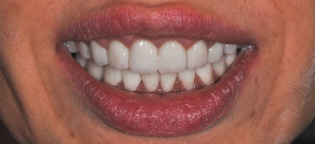 After Hollywood Smile treatment