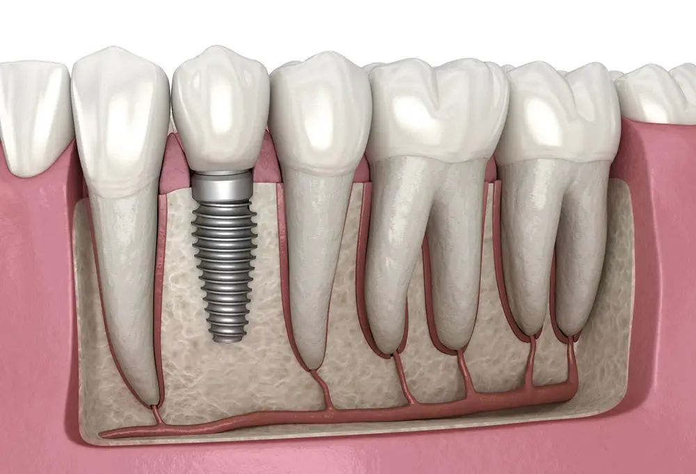 Dental Implant Treatment Turkey - Dent Health Istanbul
