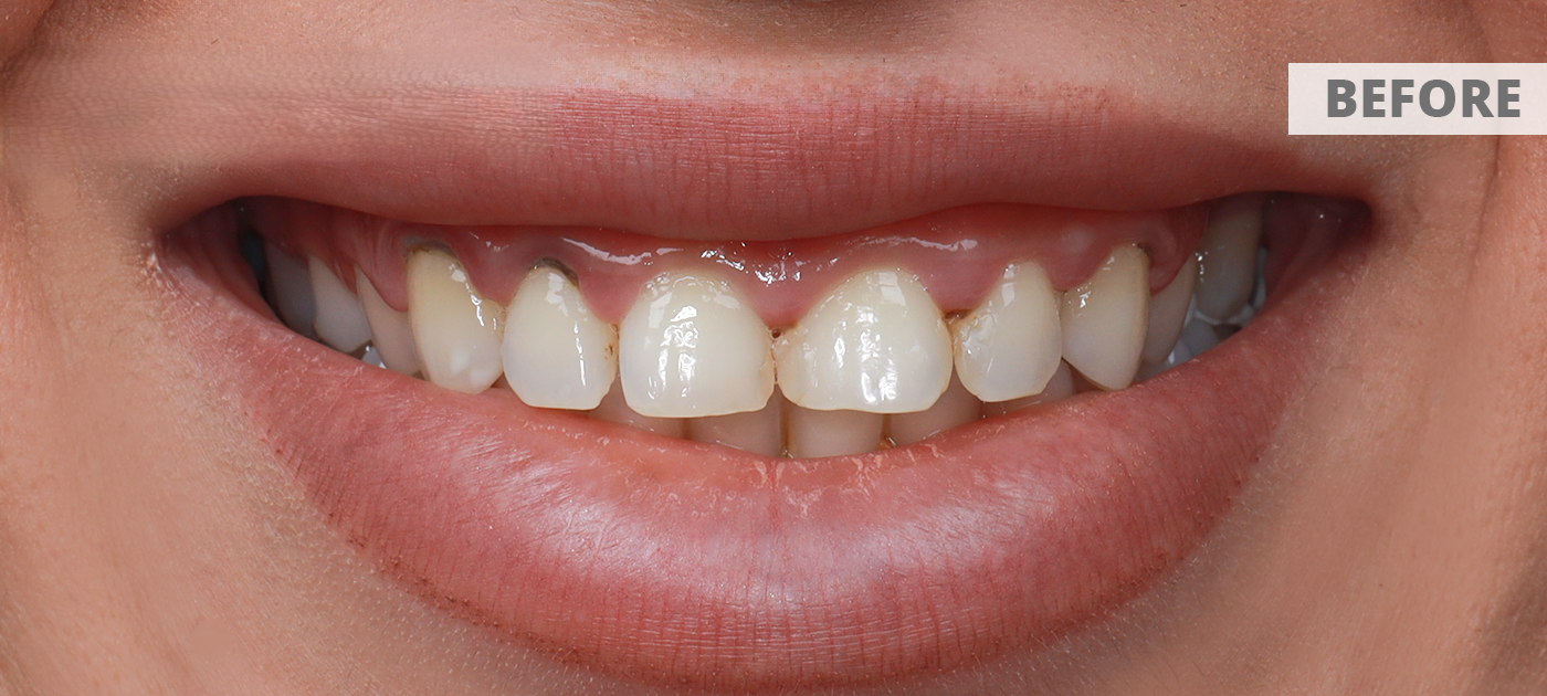 Before Hollywood Smile treatment