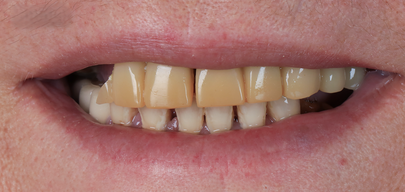 Before Hollywood Smile treatment