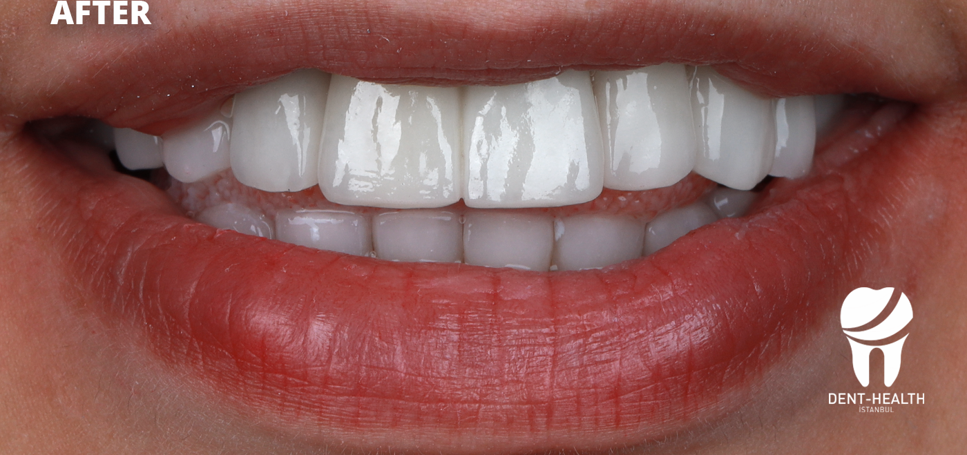 After Hollywood Smile treatment