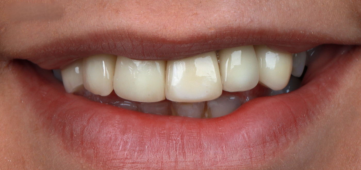 Before Hollywood Smile treatment