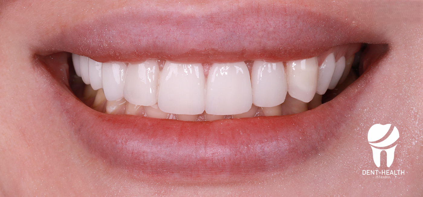 After Hollywood Smile treatment