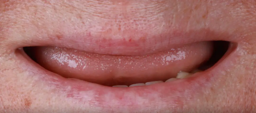 Before Hollywood Smile treatment