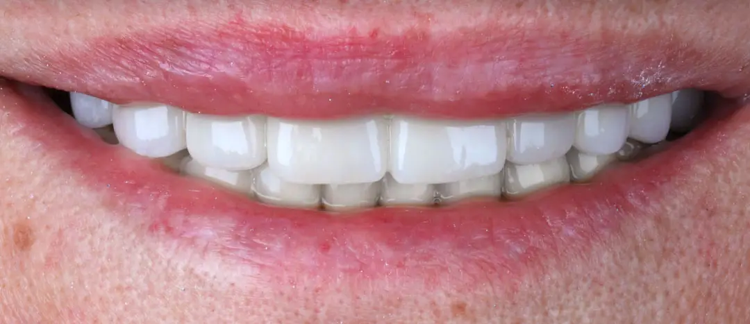 After Hollywood Smile treatment