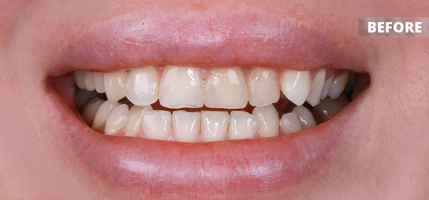 Before Hollywood Smile treatment