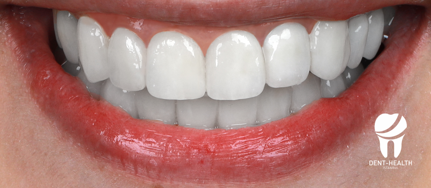 After Hollywood Smile treatment